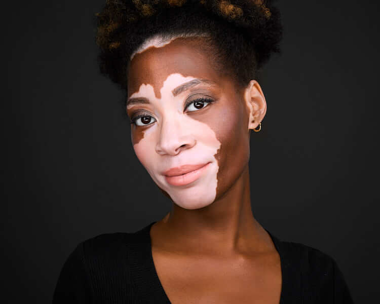Studio Model Portrait – Charlotte Commercial Photography Studio portrait of a smiling woman with vitiligo posing against a gray background.